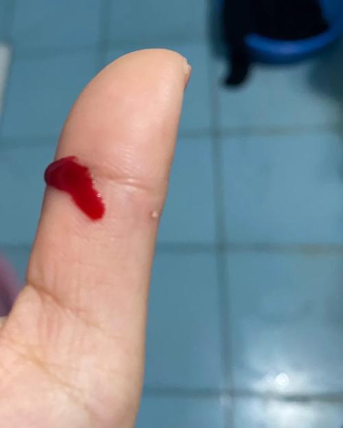 被家养仓鼠咬了一口出了点血_被仓鼠咬伤?清水冲洗消毒,狂犬疫苗不用怕! 被家养仓鼠咬了一口出了点血_被仓鼠咬伤?清水冲洗消毒,狂犬疫苗不用怕!