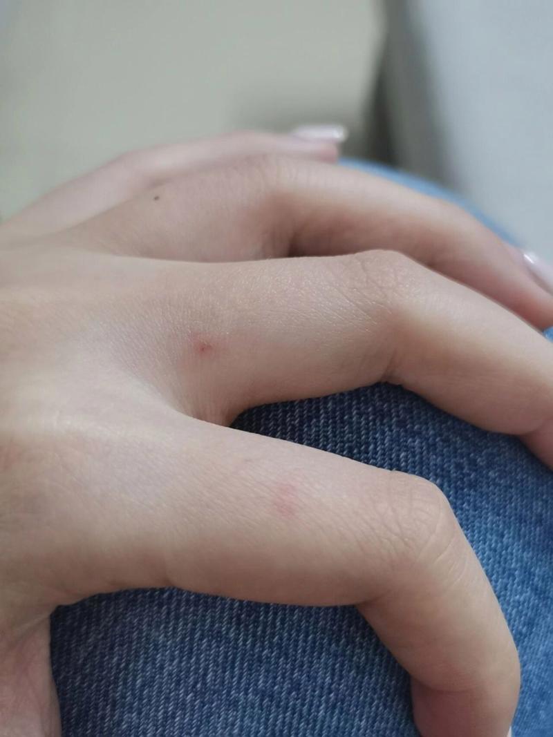 被家猫咬了一个小孔轻微出血_猫咬伤小伤口,及时冲洗消毒很重要! 被家猫咬了一个小孔轻微出血_猫咬伤小伤口,及时冲洗消毒很重要!