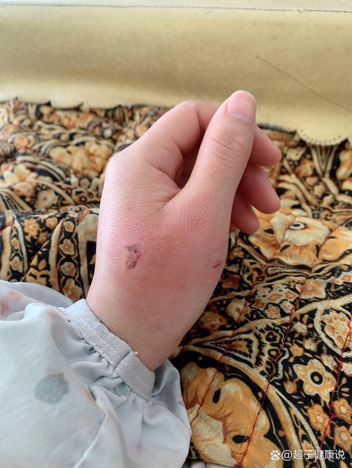 被家猫咬了一个小孔就肿了_猫咬伤肿了怎么办? 被家猫咬了一个小孔就肿了_猫咬伤肿了怎么办?