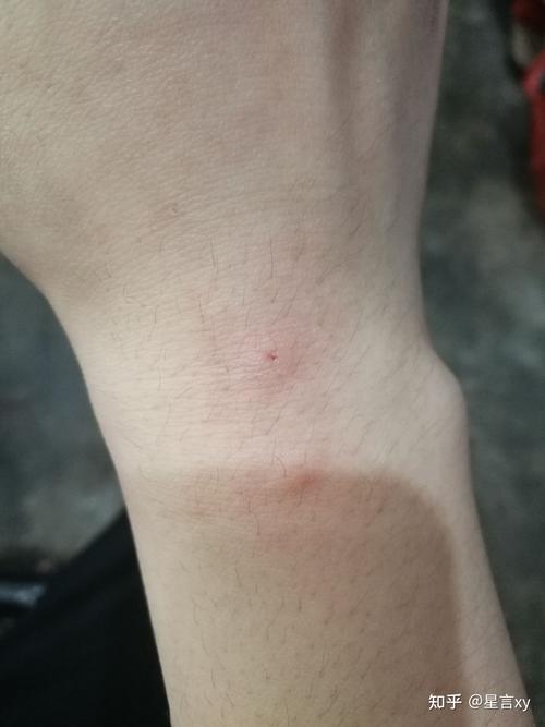 让野猫咬了出血有事吗_野猫咬伤出血?警惕狂犬病! 让野猫咬了出血有事吗_野猫咬伤出血?警惕狂犬病!