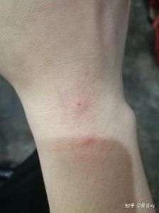 让野猫咬了出血有事吗_野猫咬伤出血？警惕狂犬病！