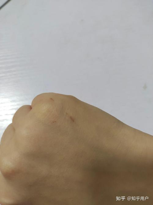 被家猫抓了一个小孔就一丁点血_猫抓伤可能感染狂犬，及时冲洗消毒重要！