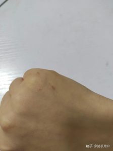 被家猫抓了一个小孔就一丁点血_猫抓伤可能感染狂犬，及时冲洗消毒重要！