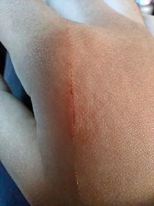 被宠物猫抓破了一点皮有事吗_猫抓伤别大意，消毒防病很重要